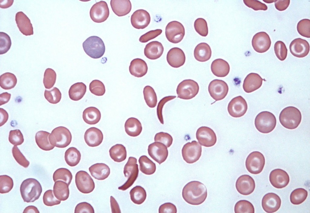 Global Blood releases more patient stats for sickle cell drug